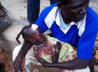 Young girl injured in aerial bombing in Southern Kordofan